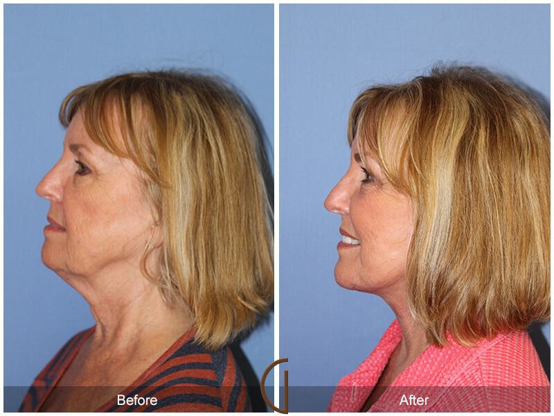 Eyelid Lift Before & After Photo