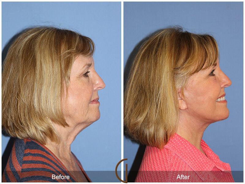 Eyelid Lift Before & After Photo