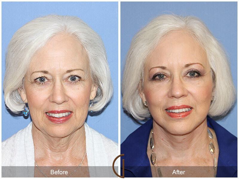 Eyelid Lift Before & After Photo