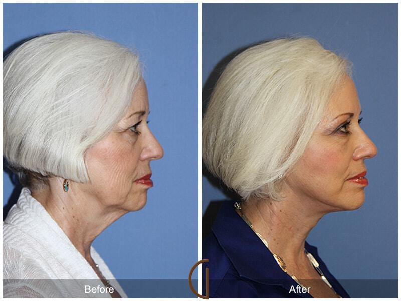 Eyelid Lift Before & After Photo