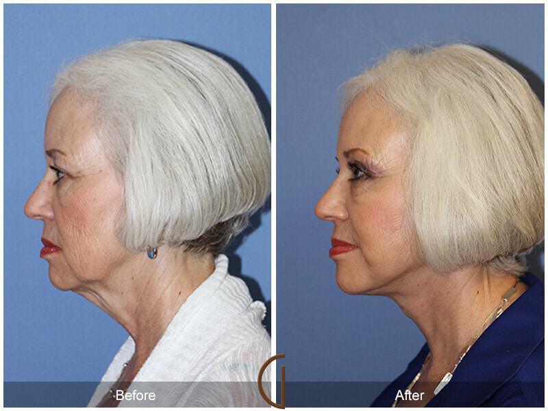 Eyelid Lift Before & After Photo