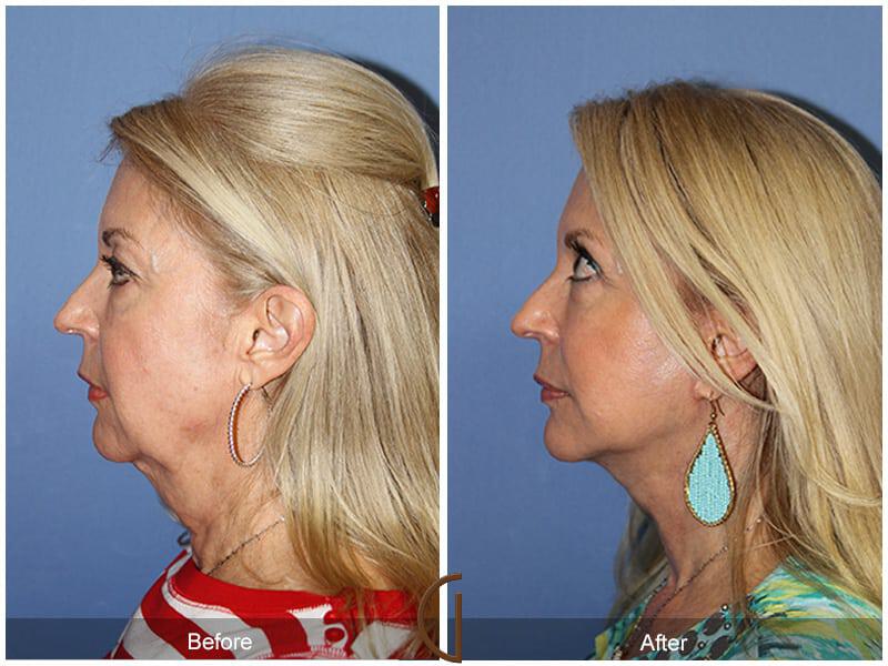 Eyelid Lift Before & After Photo