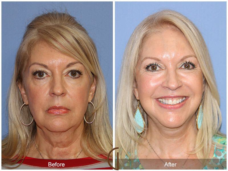 Eyelid Lift Before & After Photo