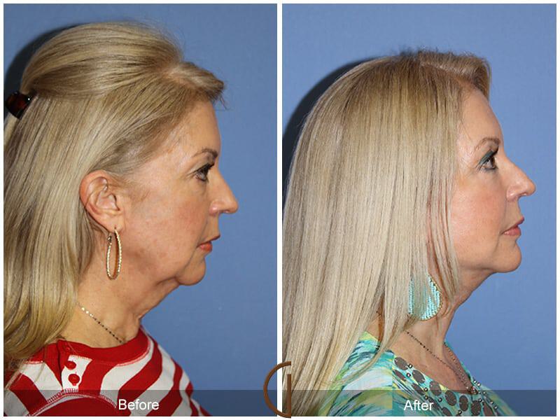 Eyelid Lift Before & After Photo