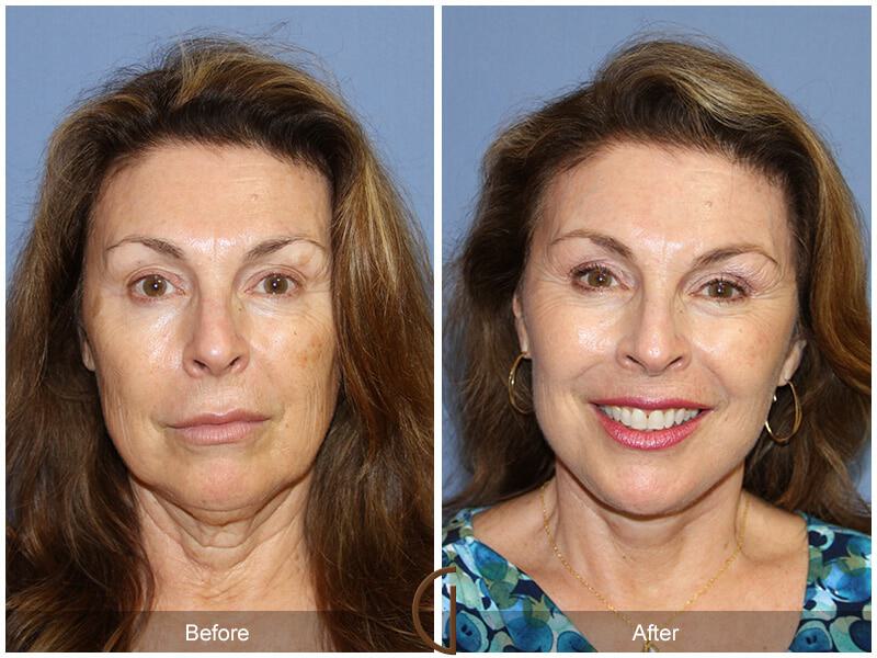 Eyelid Lift Before & After Photo