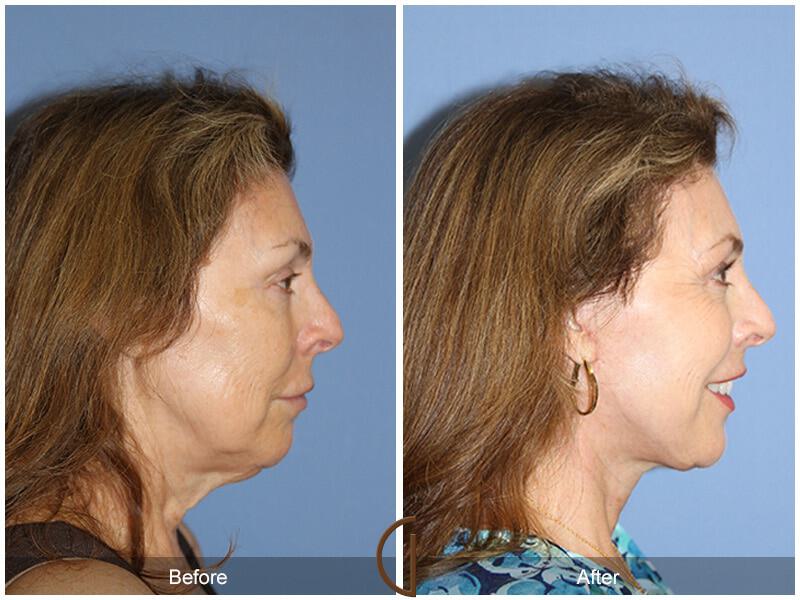 Eyelid Lift Before & After Photo