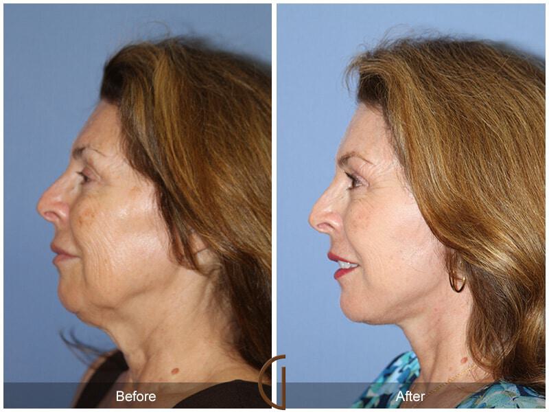 Eyelid Lift Before & After Photo