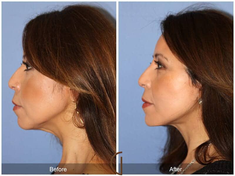 Eyelid Lift Before & After Photo