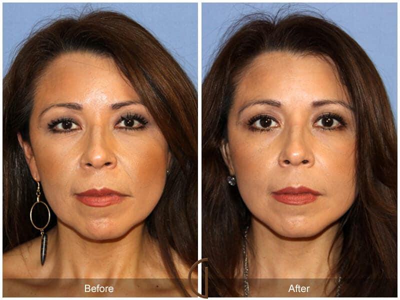 Eyelid Lift Before & After Photo