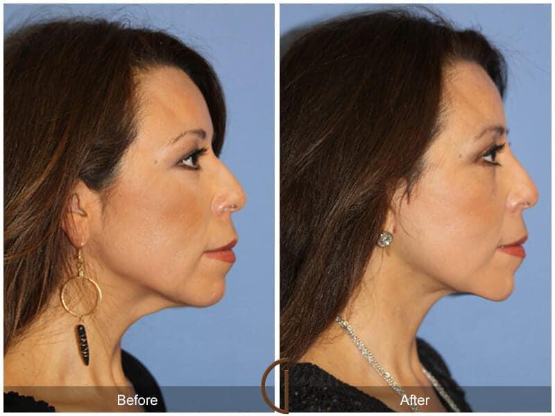 Eyelid Lift Before & After Photo