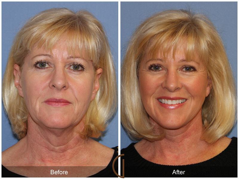 Eyelid Lift Before & After Photo