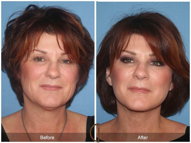 Eyelid Lift Before & After Photo