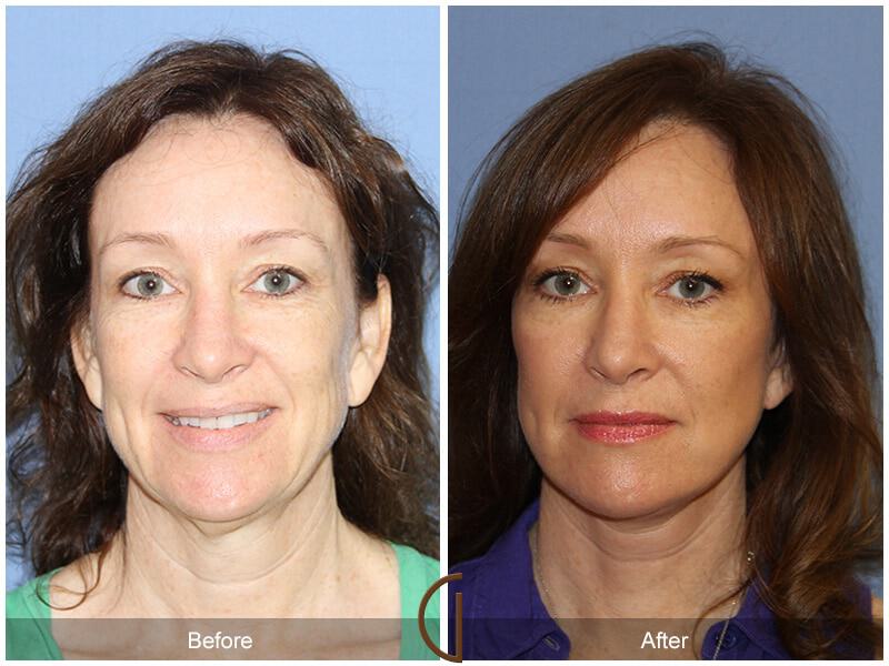 Eyelid Lift Before & After Photo