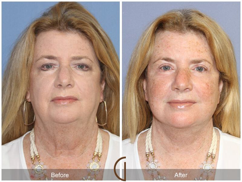 Eyelid Lift Before & After Photo