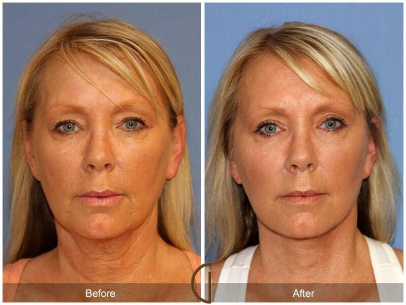 Eyelid Lift Before & After Photo