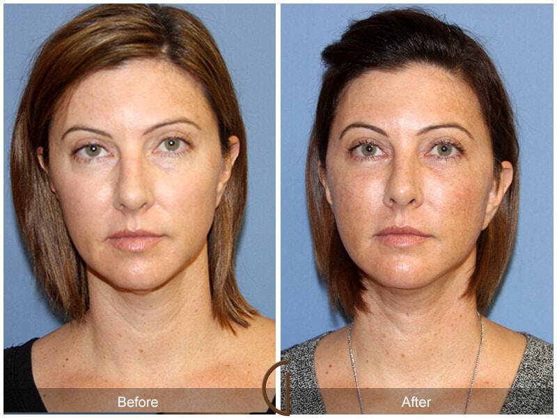 Eyelid Lift Before & After Photo