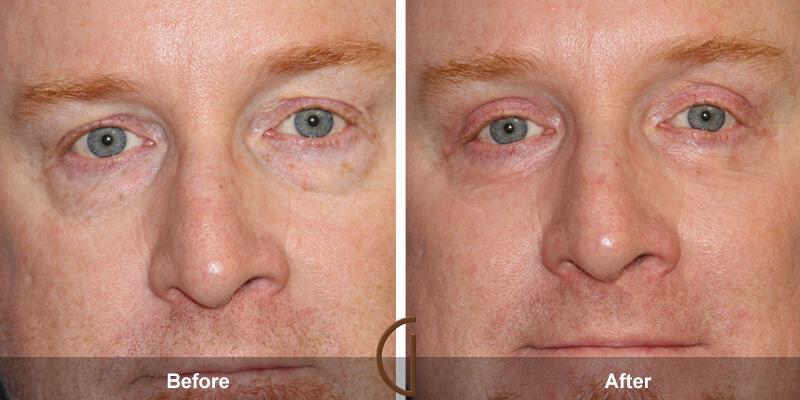 Eyelid Lift Before & After Photo