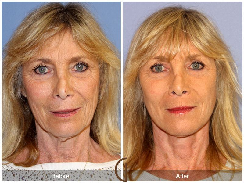 Eyelid Lift Before & After Photo