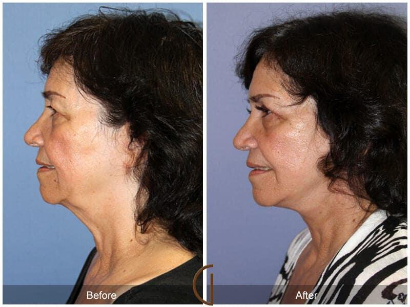 Eyelid Lift Before & After Photo