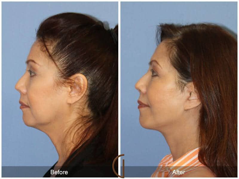 Eyelid Lift Before & After Photo