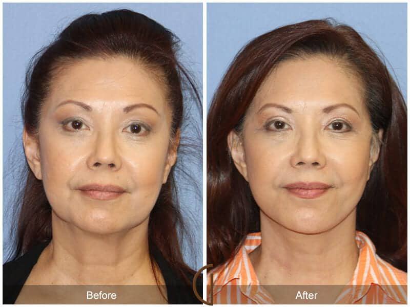 Eyelid Lift Before & After Photo