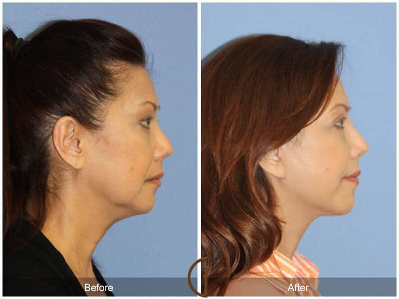 Eyelid Lift Before & After Photo