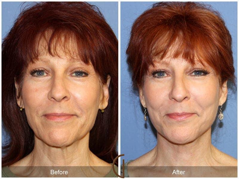 Eyelid Lift Before & After Photo