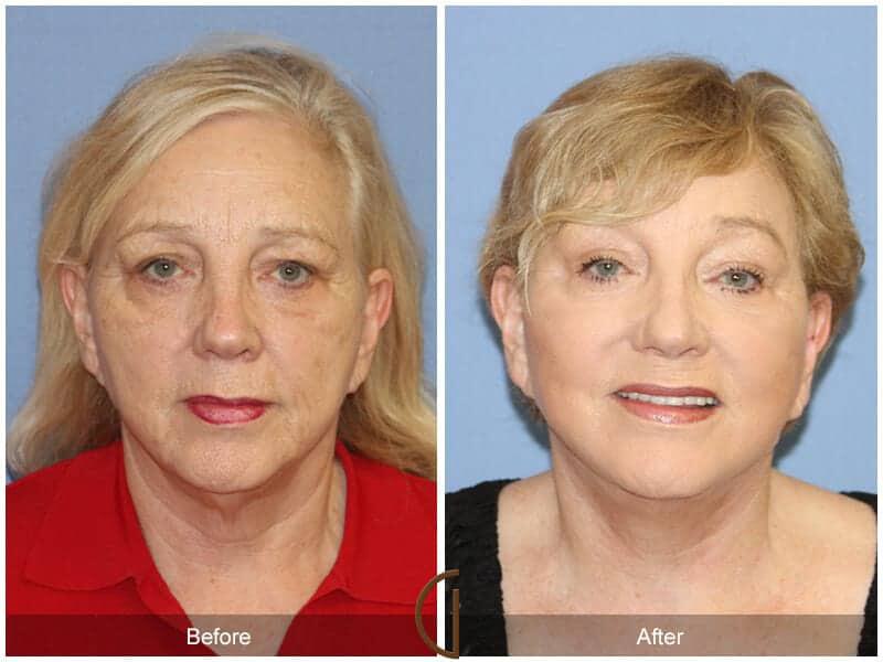 Eyelid Lift Before & After Photo