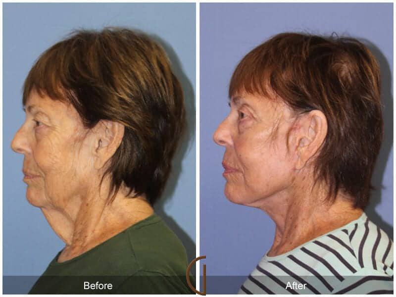 Eyelid Lift Before & After Photo