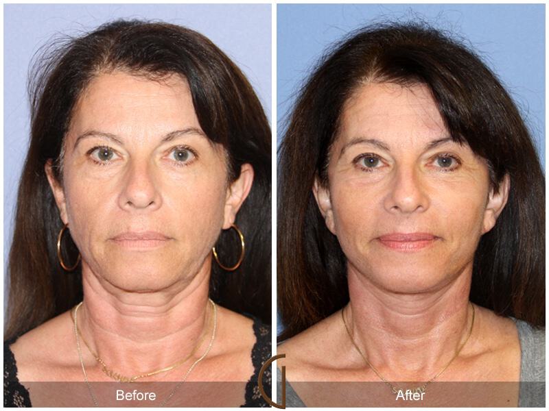 Eyelid Lift Before & After Photo