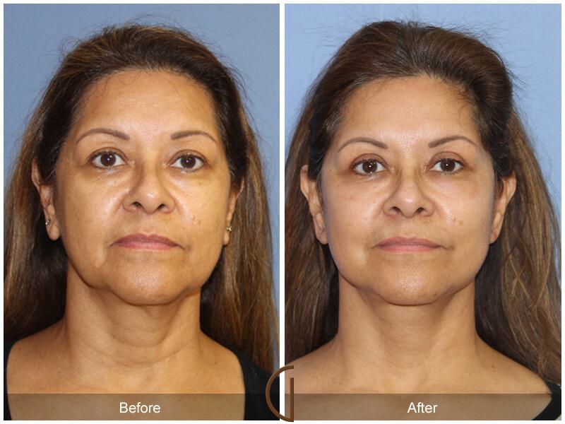 Eyelid Lift Before & After Photo