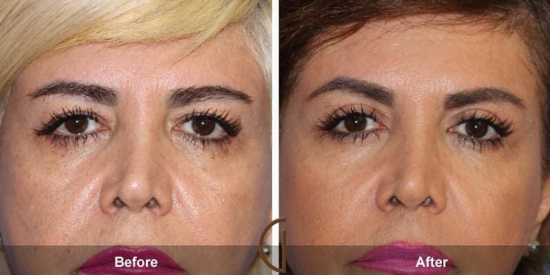 Eyelid Lift Before & After Photo