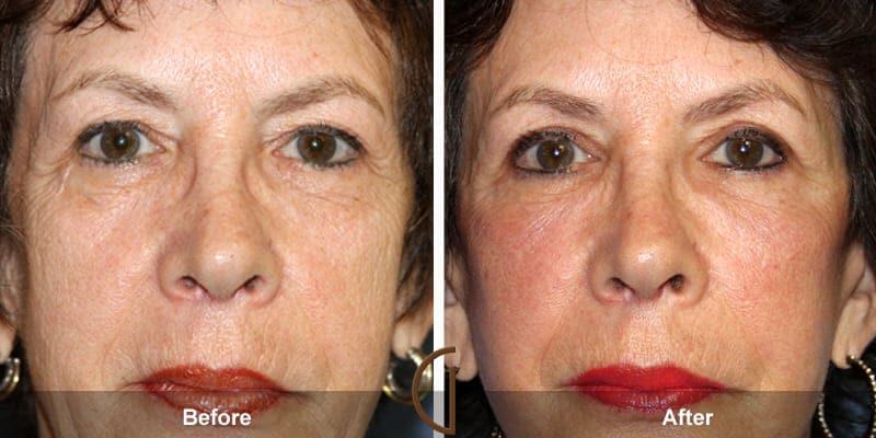 Eyelid Lift Before & After Photo