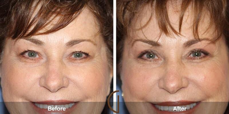 Eyelid Lift Before & After Photo