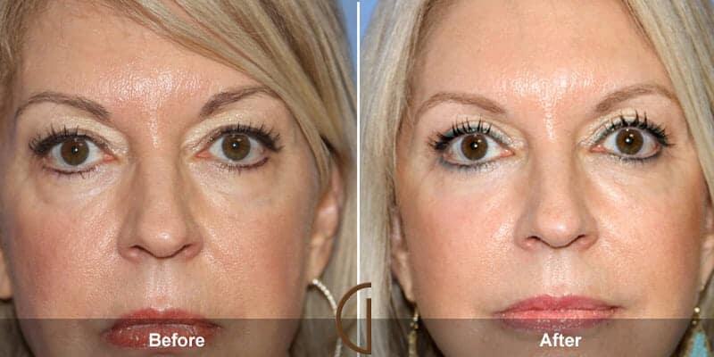 Eyelid Lift Before & After Photo