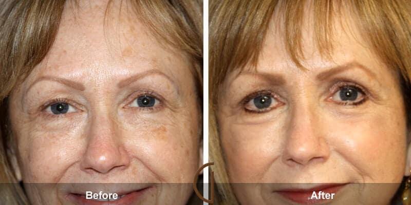 Eyelid Lift Before & After Photo