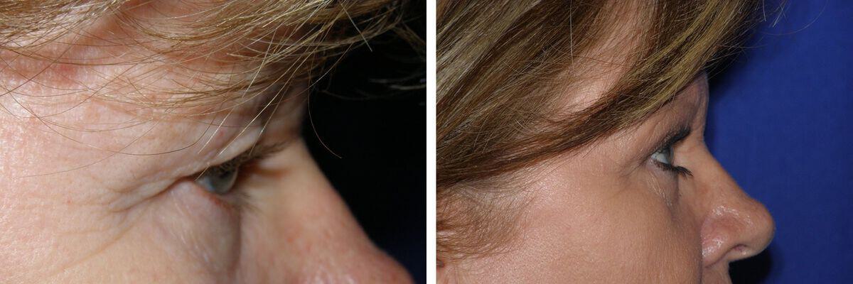 Eyelid Lift Before & After Photo