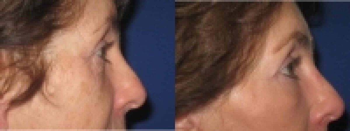 Eyelid Lift Before & After Photo