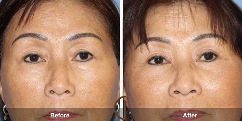 Eyelid Lift Before & After Photo