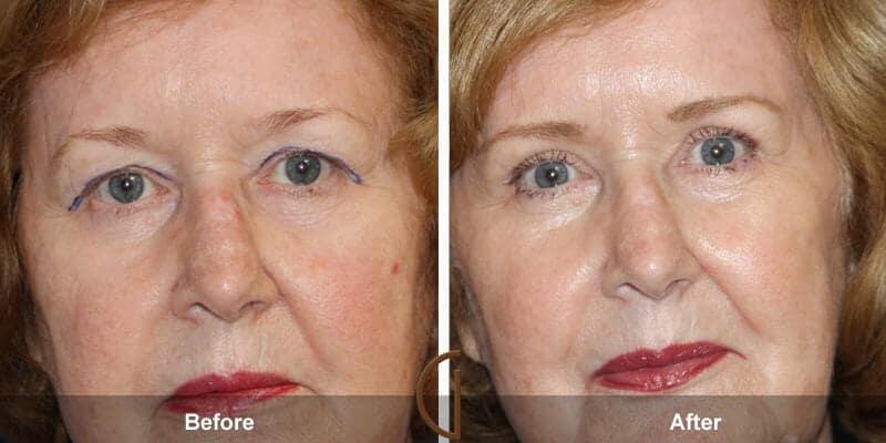 Eyelid Lift Before & After Photo