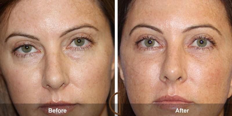 Eyelid Lift Before & After Photo