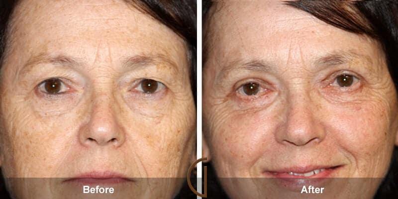 Eyelid Lift Before & After Photo