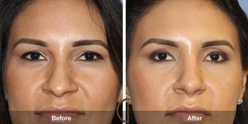 Eyelid Lift Before & After Photo