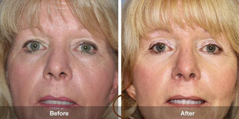 Eyelid Lift Before & After Photo