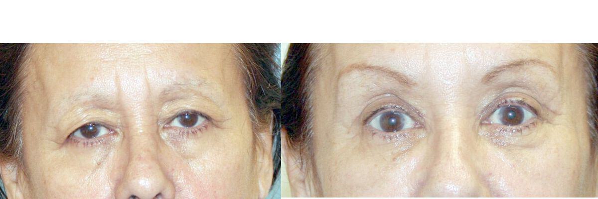 Eyelid Lift Before & After Photo