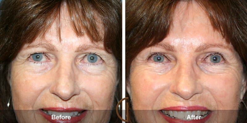 Eyelid Lift Before & After Photo