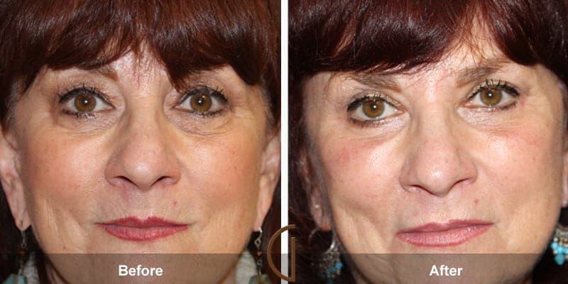 Eyelid Lift Before & After Photo