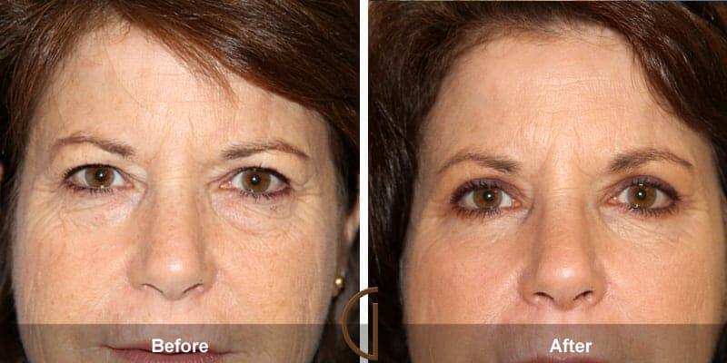 Eyelid Lift Before & After Photo