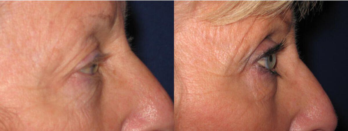 Eyelid Lift Before & After Photo