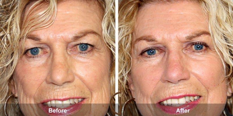 Eyelid Lift Before & After Photo